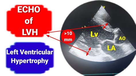 left ventricular dysfunction grade 1.